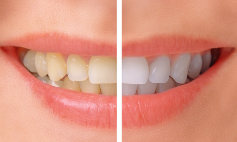 el-efecto-del-tabaco-en-una-salud-bucodental