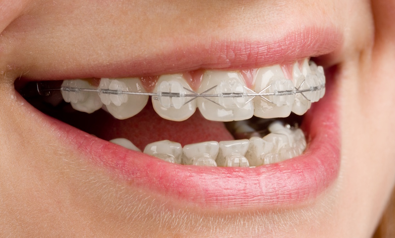 cuanto-cuesta-un-implante-dental