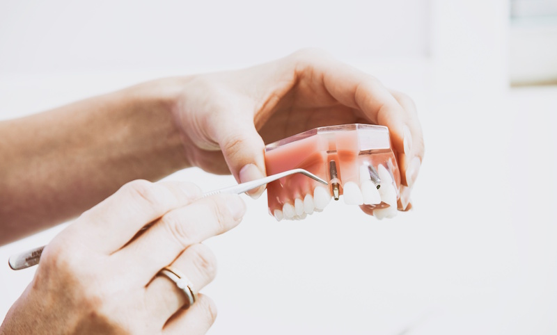 cuanto-cuesta-un-implante-dental